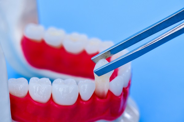 Recovering From Getting Dental Implants