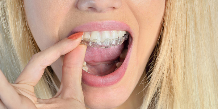 Invisalign in Brooklyn NY - Clear, Invisible Braces for Teens & Adults